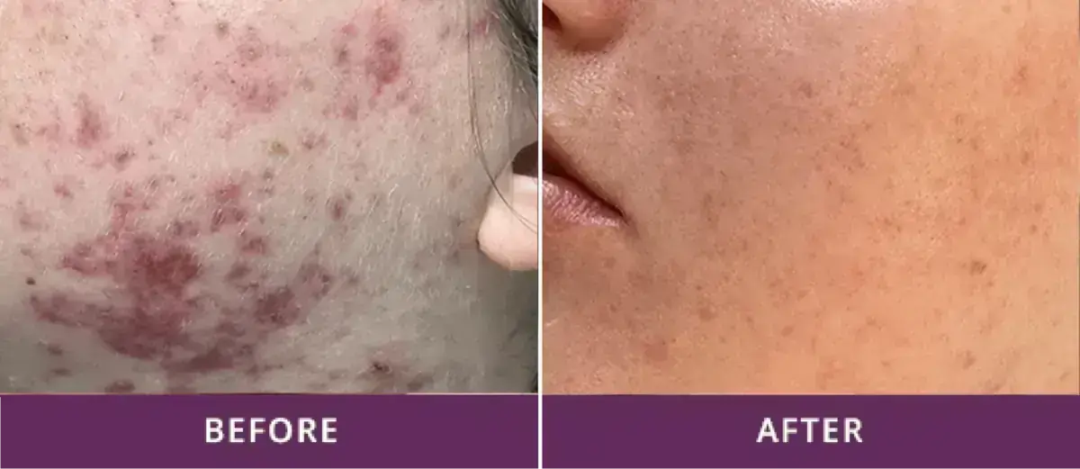 Acne Clearance 