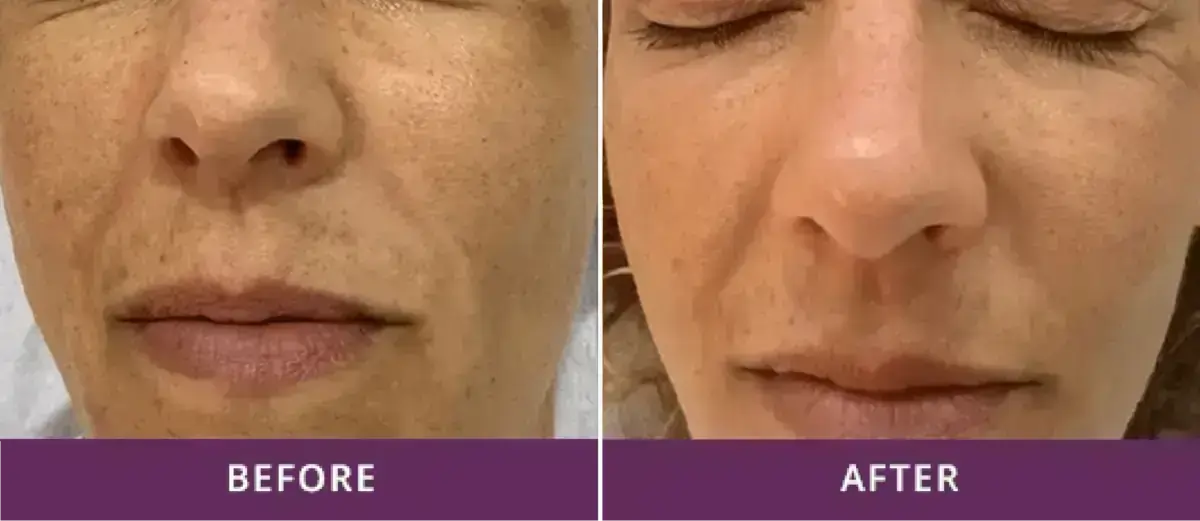 Skin Rejuvenation 