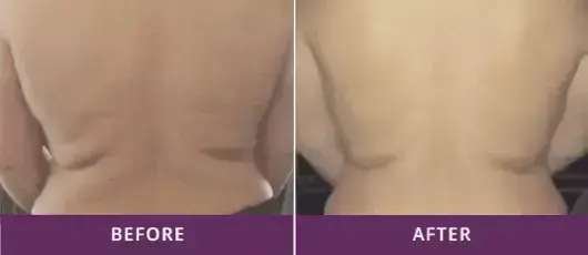 Body Contouring