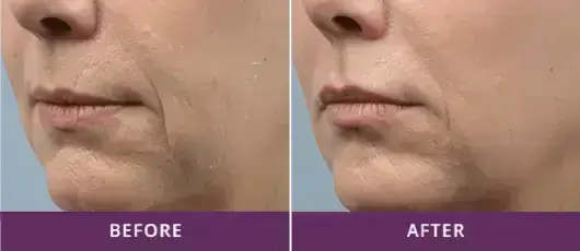 Skin Tightening 