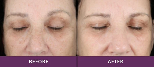 WRINKLE REDUCTION