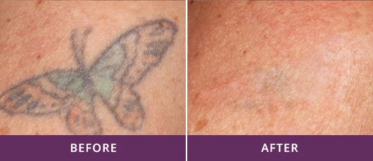 EFFICIENT TATTOO REMOVAL