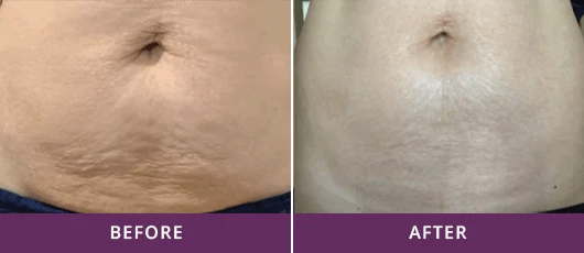 Reduced Abdomen Stretch Marks 