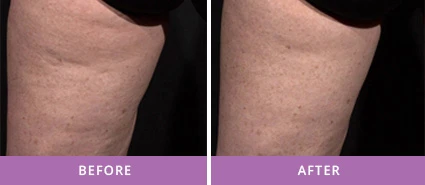TEMPORARY CELLULITE REDUCTION