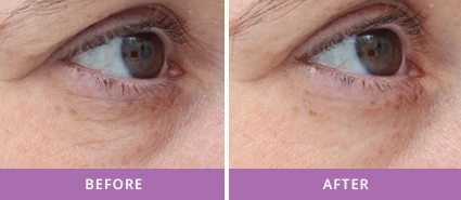 WRINKLE REDUCTION