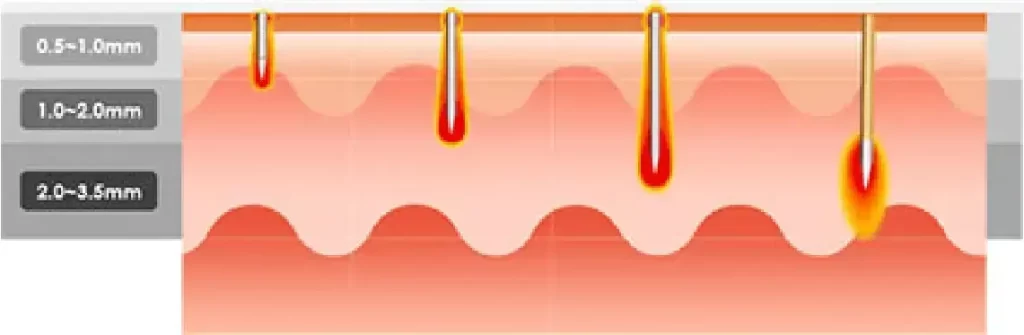 Secret RF Treatments