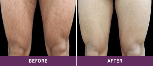 SMOOTH, SILKY LEGS