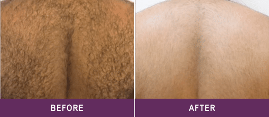CONFIDENT, HAIR-FREE BACK