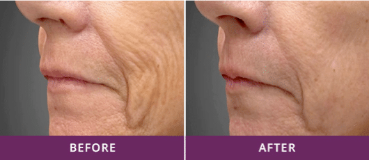 REDUCTION OF FINE LINES & WRINKLES