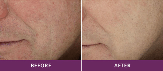 IMPROVED SKIN TEXTURE