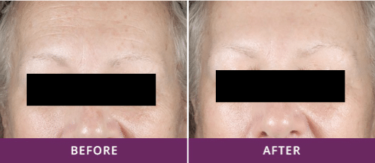 SKIN REVITALIZATION