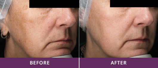 FRACREVIVE® PHOTOREJUVENATION