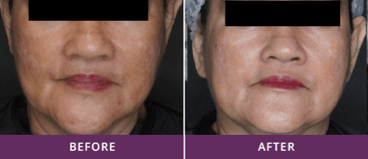 SCARS AND RESURFACING