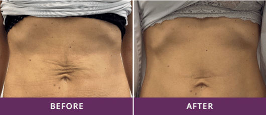 SCULPT & FIRM, NO SURGERY NEEDED