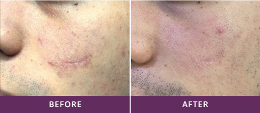 SIMPLE SOLUTION FOR LESIONS