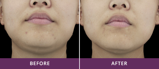 INCREASED COLLAGEN DENSITY