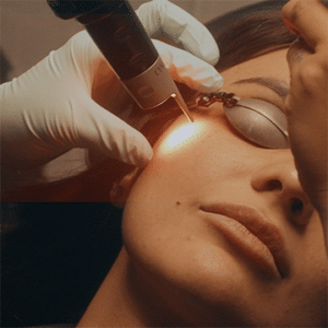 Treatment Photo of PicoV, a combination of PicoSure Pro and DermaV.