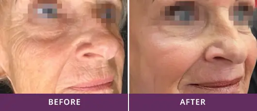COLLAGEN RENEWAL