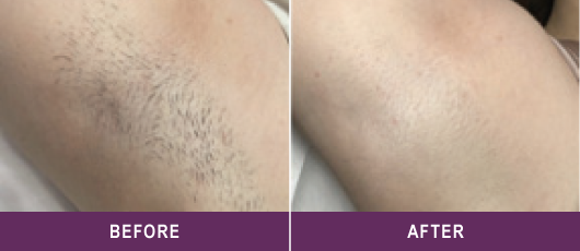 SMOOTH, HAIR-FREE SKIN