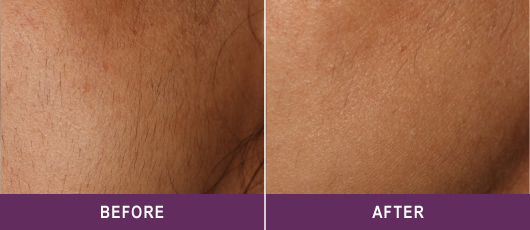 IMPROVED SKIN TEXTURE AND RADIANCE