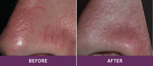 REDUCED APPEARANCE OF LEG VEINS