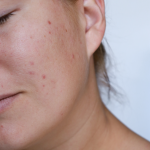 Mosaic 3D by SpectruMed is a the perfect device for treating acne scars