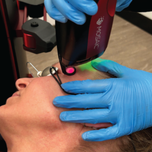 Mosaic 3D from SpectruMed is for scars management.
