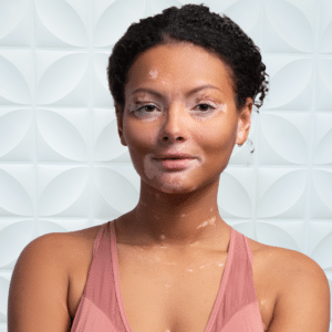 Exciplex Transforms Vitiligo Treatment