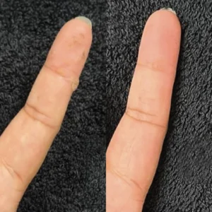 CryoPen before and after clearing warts