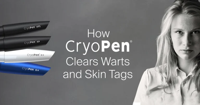 A Touch of Frost, a Clean Slate: How CryoPen Clears Warts and Skin Tags