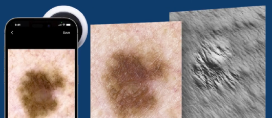 MELANOMA & SKIN CANCER MONITORING