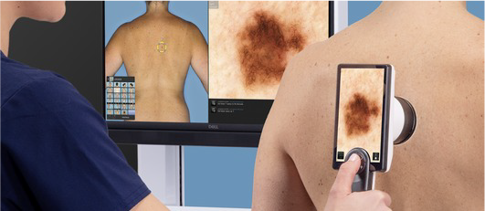 TOTAL BODY SKIN SURVEILLANCE